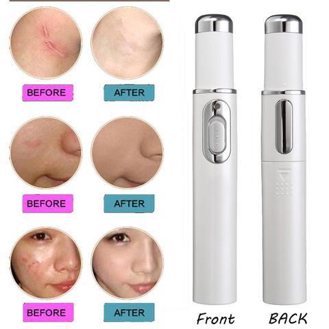 Blue Light Therapy Acne Laser Pen Soft Scar Wrinkle Removal Treatment Device Skin Care Beauty Equipment - iztia