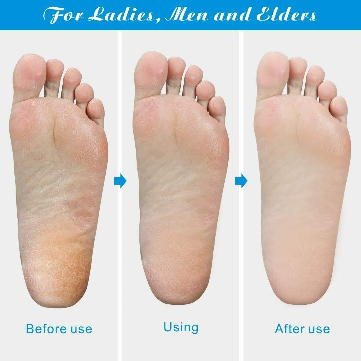 Foot Rasp File Callus Remover Pedicure Tool Dead Hard Skin Scraper Scrubber Tool - iztia